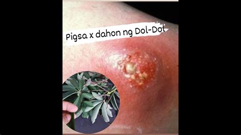 gamot sa matag tiki